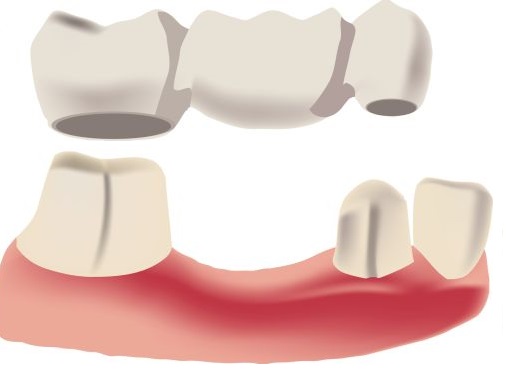 Dental Bridge, Implant supported bridge in Batavia