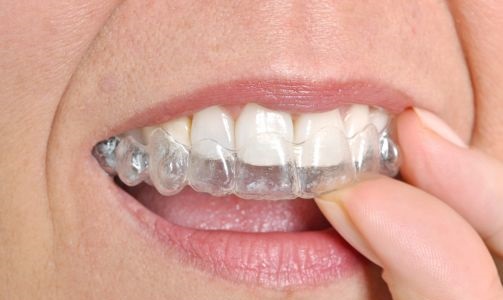 Clear Braces