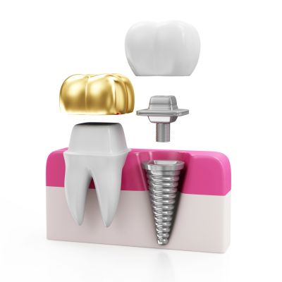 Batavia dentist offers ceramic crown Batavia dentist offers ceramic crown