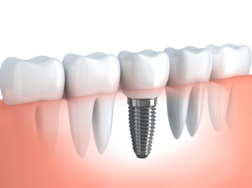 Dental Implant in Geneva IL Dental Implant in Geneva IL