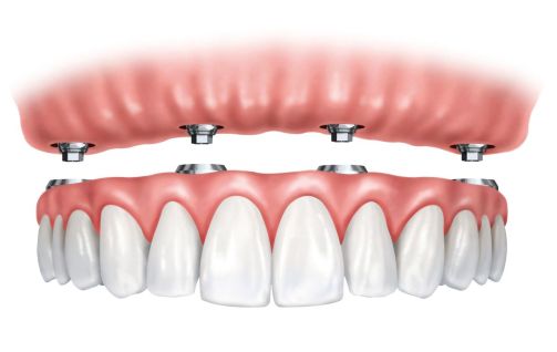 Implant supported Denture, All-on-4, Fixed Denture Implant supported Denture, All-on-4, Fixed Denture