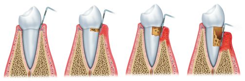 Gum Treatment in Batavia