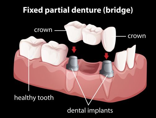 Implant supported bridge in Geneva