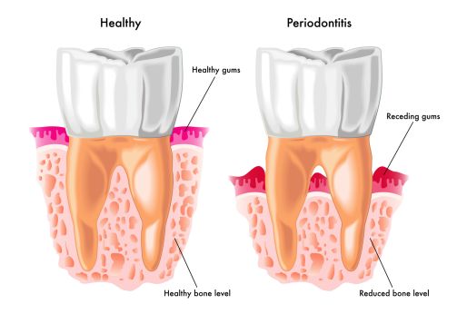 Periodontal Surgery at Batavia & Geneva Periodontal Surgery at Batavia & Geneva