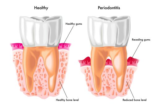 Periodontal Surgery at Batavia & Geneva 