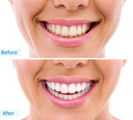 Batavia dentist offers teeth whitening Batavia dentist offers teeth whitening