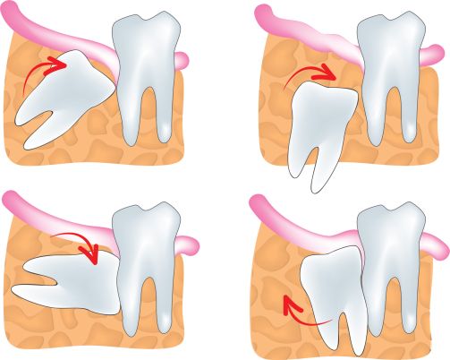 Wisdom Tooth Extraction Wisdom Tooth Extraction